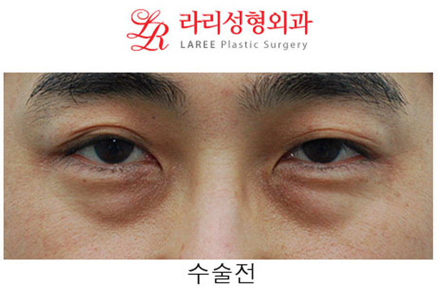 Under-Eye Fat Repositioning Before and After in Your 40s image 1