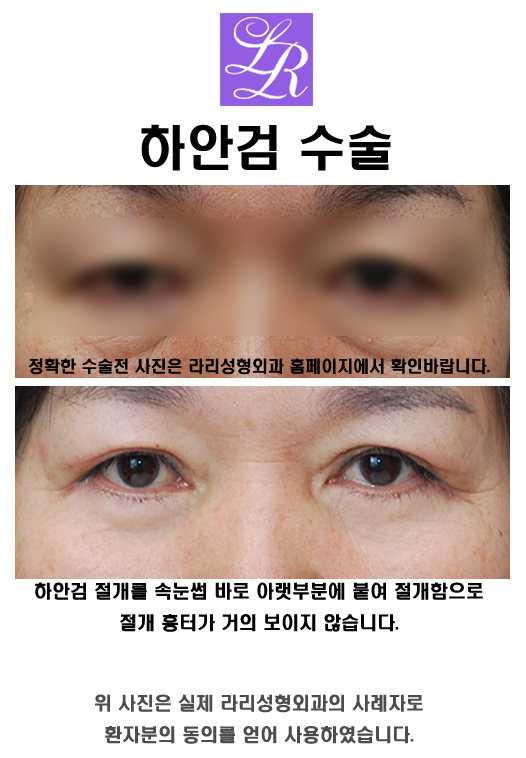 Lower Eyelid Surgery for Sagging Eyes — Lower Blepharoplasty to Correct Under-Eye Sagging image 4