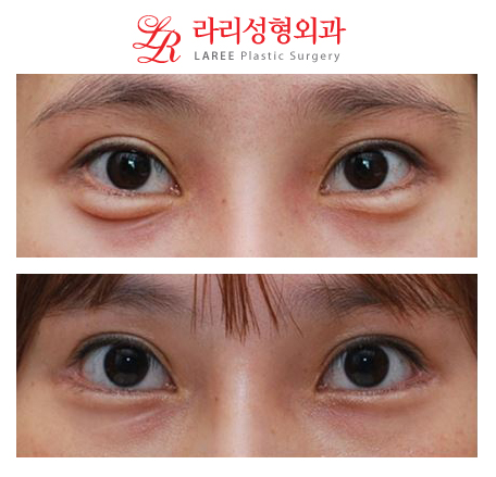 뒤트임/뒷트임 사진 후기 정보☆ 관련 이미지 3
