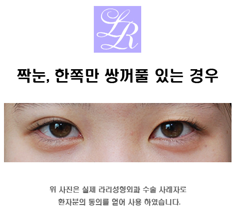 Correcting Uneven Eyes with a Double Eyelid on Only One Side image 2