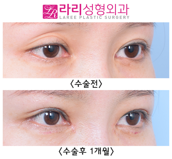 [라리성형외과] 피곤해 보이는 눈, 윗눈꺼풀 지방이식과 쌍수재수술로 예쁘게 재탄생 관련 이미지 2