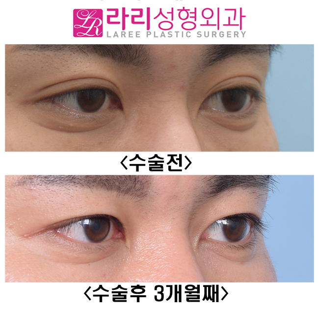 [라리성형외과] 원래 없었던 것처럼 보이는 자연쌍꺼풀없애기 관련 이미지 4