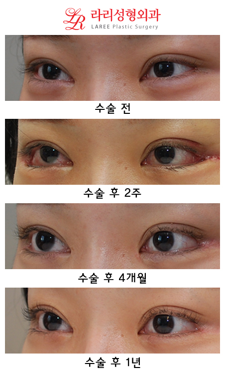 뒤트임재수술 처음과는 다른 뒷트임 후기 관련 이미지 3