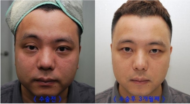 쌍꺼풀없애기 "나 대세임? " 관련 이미지 13