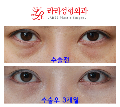 뒤트임, 눈밑지방재배치 동시에 가능? 관련 이미지 1