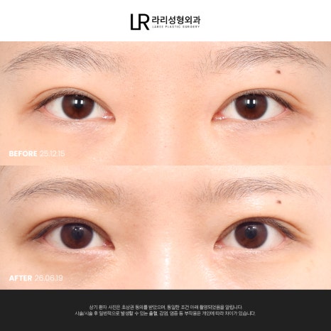 [라리성형외과] 쌍꺼풀수술 전후 사진으로 보는 눈매교정의 중요성 관련 이미지 6