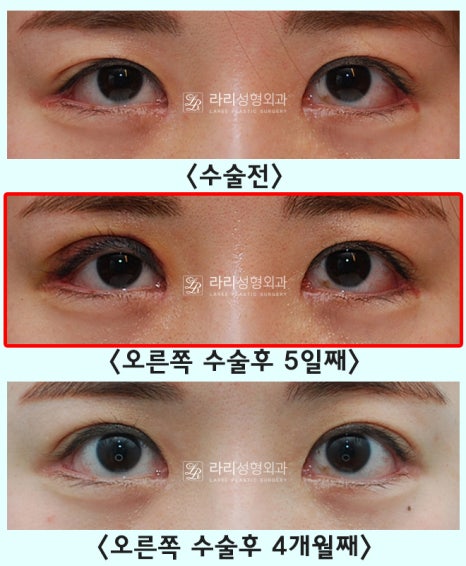 [Lari Plastic Surgery] One-sided double eyelid surgery to correct uneven eyes: Is it possible to get double eyelids on only one eye? image 5