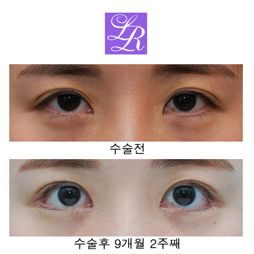 Changing Eyelid Crease Shape with Double Eyelid Reversal Surgery image 1
