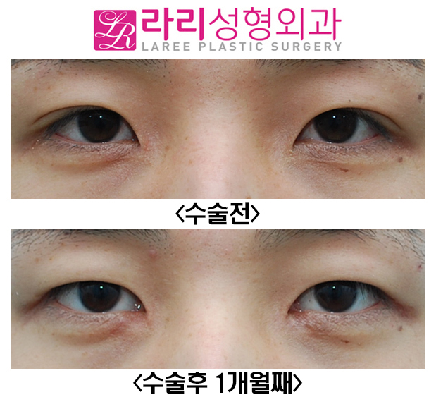 [Rari Plastic Surgery] Removing Double Eyelids Without a Crease and Medial Canthoplasty Are Effective for Changing the Look image 1