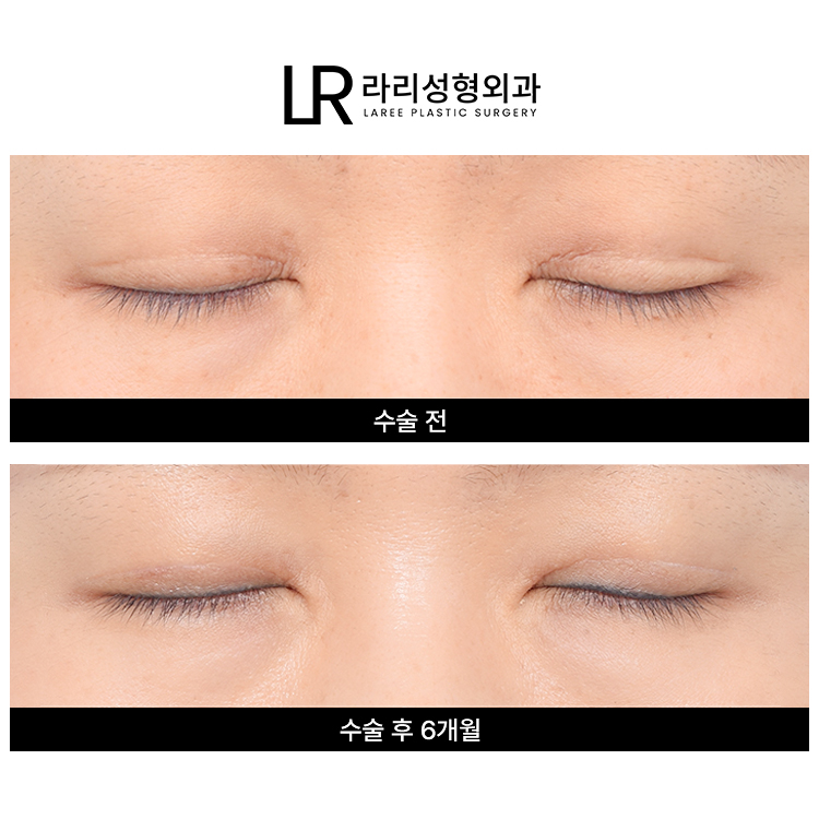 [라리성형외과] 흐릿한 눈, 소세지 쌍꺼풀 인라인 속쌍으로 깔끔하게 관련 이미지 3
