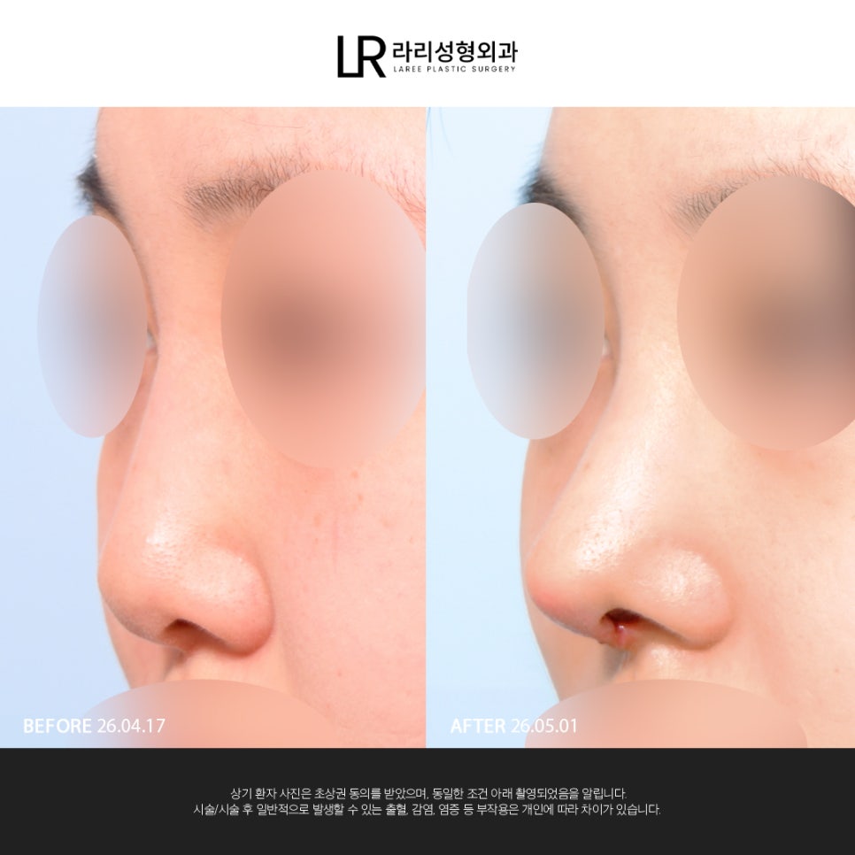 [Lari Plastic Surgery] If You Are Considering Nose Surgery, Do Not Get Nose Thread-Lifting Procedures Like Misko / Hiko!! image 4