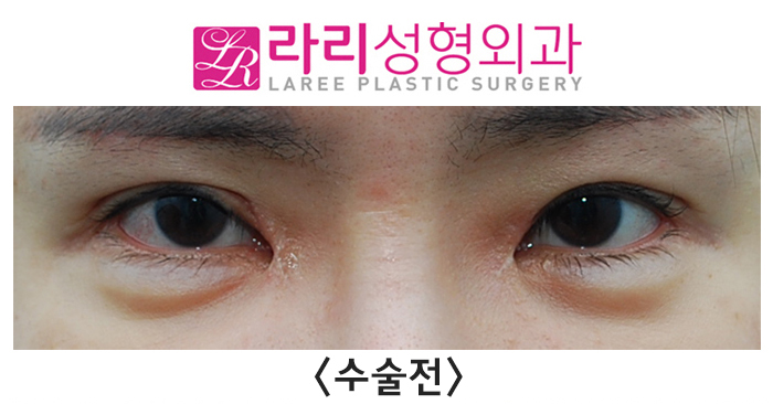 [라리성형외과] "절개쌍꺼풀재수술, 앞트임 복원 후 앞트임재수술, 눈꼬리내리기 뒤트임재수술" 효과 한 번에 보기 관련 이미지 1