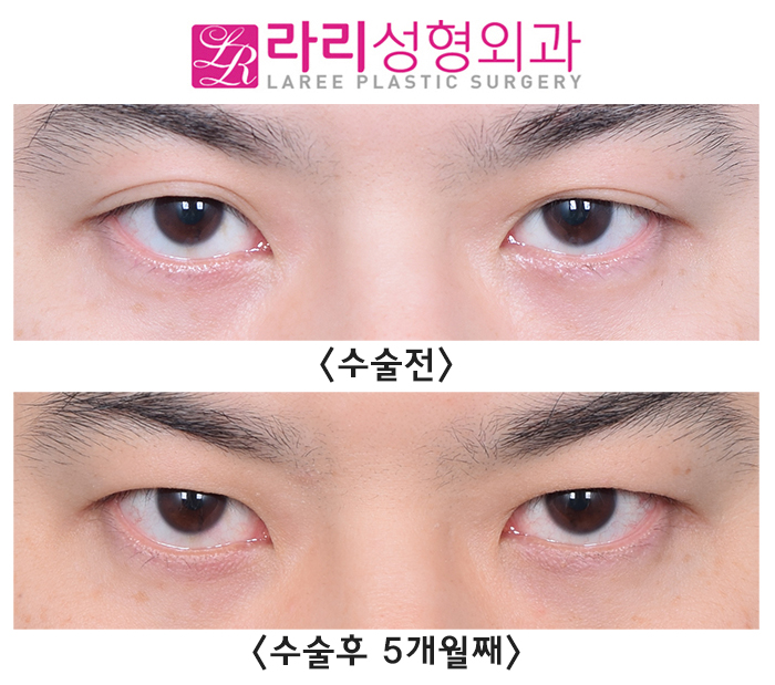 [Lari Plastic Surgery] Completely monolid, removing a natural double eyelid: the eyes close well too. image 1