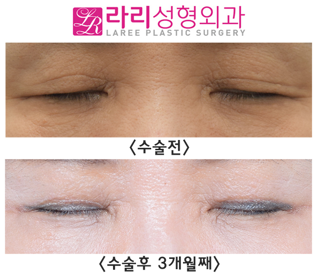 [Lari Plastic Surgery] The secret to looking 10 years younger in middle age is upper eyelid surgery! image 4