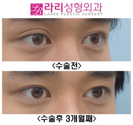 [라리성형외과] 자연 짝눈, 속쌍꺼풀 쌍꺼풀없애기로 짝짝이교정 관련 이미지 2