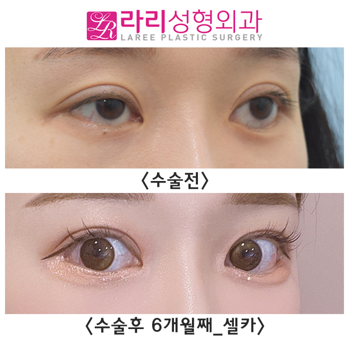 [라리성형외과] 쌍꺼풀재수술, 밑트임복원, 뒤트임재수술 후 다시 태어난 눈 리얼 셀카 후기 관련 이미지 3
