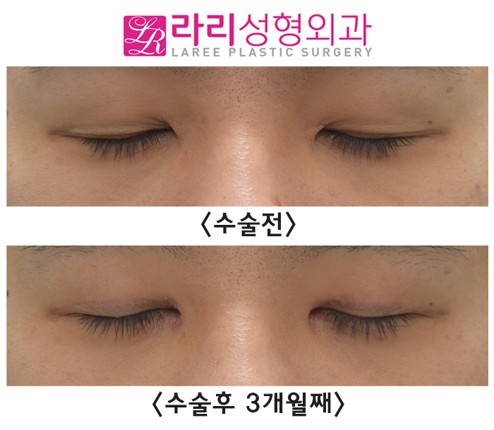 [라리성형외과] 붓기 최소화하는 자연스러운 속쌍꺼풀 남자 절개눈매교정 앞트임수술 전후사진 관련 이미지 4