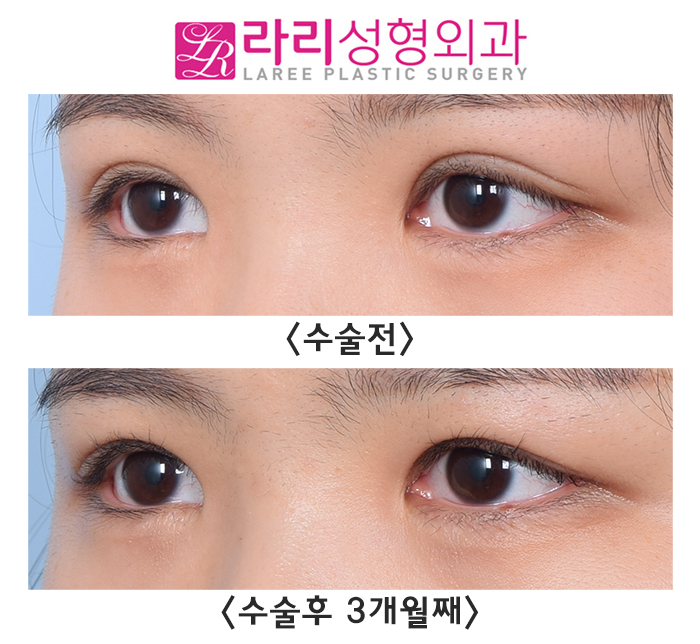 [Rari Plastic Surgery] Making Small Eyes Look Bigger with Revision Double Eyelid Surgery and Sausage Correction image 2