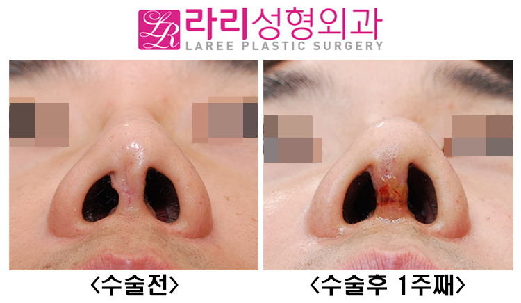[라리성형외과] 코재수술 : 미용 목적만이 아닌 경우, 복원과 재건 관련 이미지 4