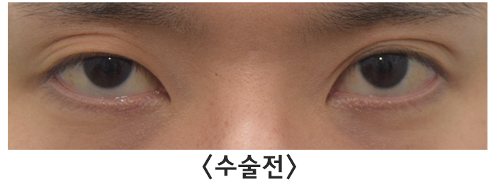 [라리성형외과] 여러 가지 쌍꺼풀 생기는 눈 무쌍으로 바꿔드립니다. 관련 이미지 1