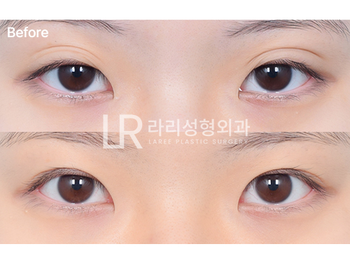 [라리성형외과] Revision Double-Eyelid Surgery if Buried-Suture Double Eyelids Come Undone? No, No—Removing the Double Eyelid! image 6