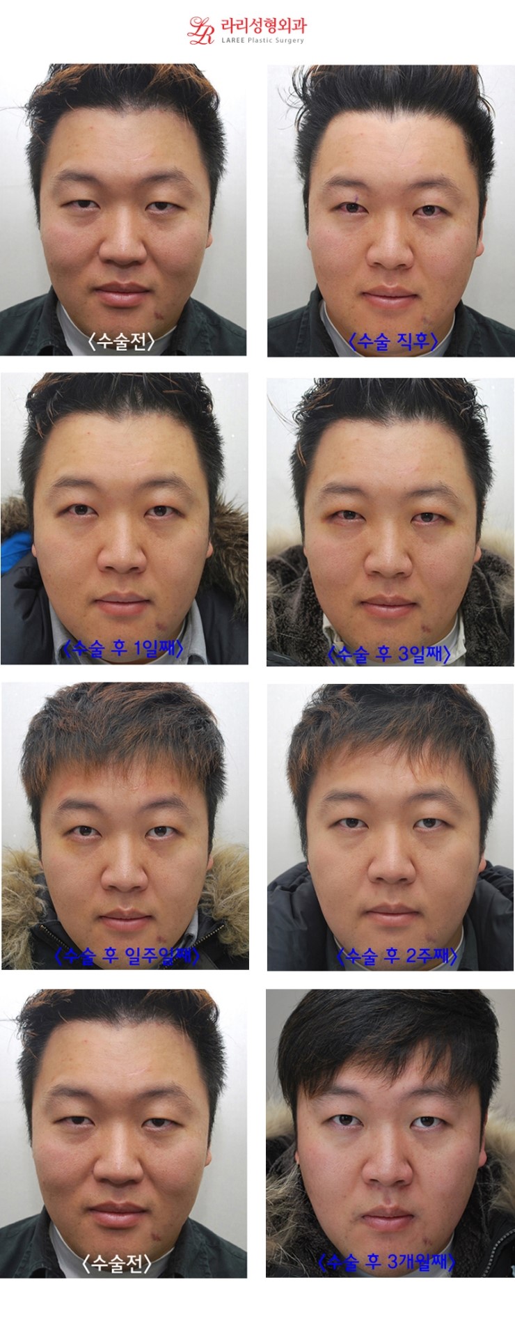 Single Eyelids Are the Trend for Men!!! XTM Men’s No-Double-Eyelid One-Day Eye Correction Before-and-After Progress Photos☆ image 1