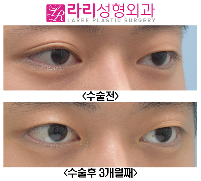 [라리성형외과] 한쪽 쌍수? 한쪽쌍꺼풀없애기? 반대쪽에 쌍꺼풀이 생겨요 관련 이미지 2