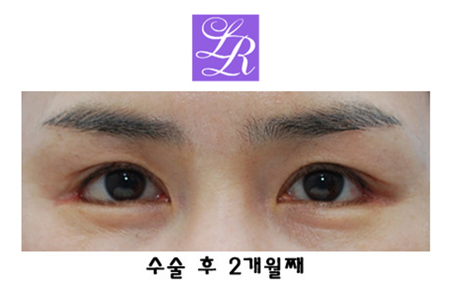 짝눈교정방법 중(쌍꺼풀재수술 + 눈매교정) 확인해야 될 사항 관련 이미지 4