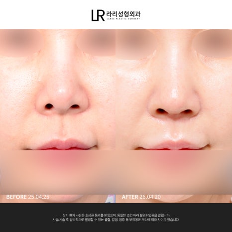 [라리성형외과] 사진 찍으면 유독 길어 보이는 인중, 인중축소로 달라질 수 있을까? 관련 이미지 1