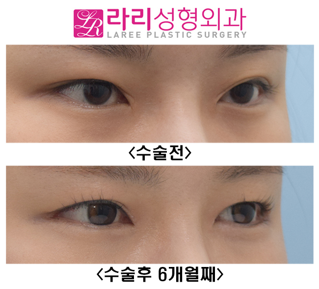 [라리성형외과]  앞트임복원수술 하지 않고 앞트임흉터 제거하는 방법 관련 이미지 3