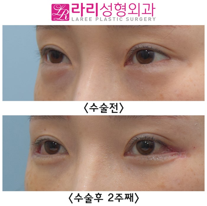 [라리성형외과] 뒤트임재수술 실밥 제거 당일 수술후 2주째 단기 경과 전후 사진 관련 이미지 2