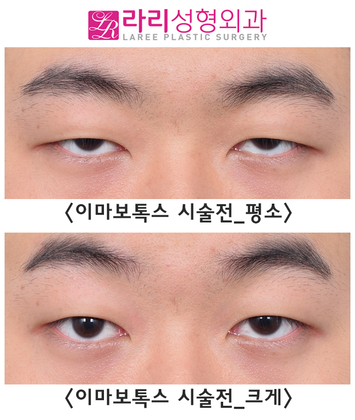 [Lari Plastic Surgery] Before-and-After Comparison Photos of Incisional Eye Correction Surgery That Restores Vision — Not from an Ophthalmology Clinic, but from a Plastic Surgery Clinic image 1