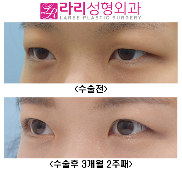 [라리성형외과] 여자도 무쌍눈매교정이 어울릴까? 관련 이미지 5