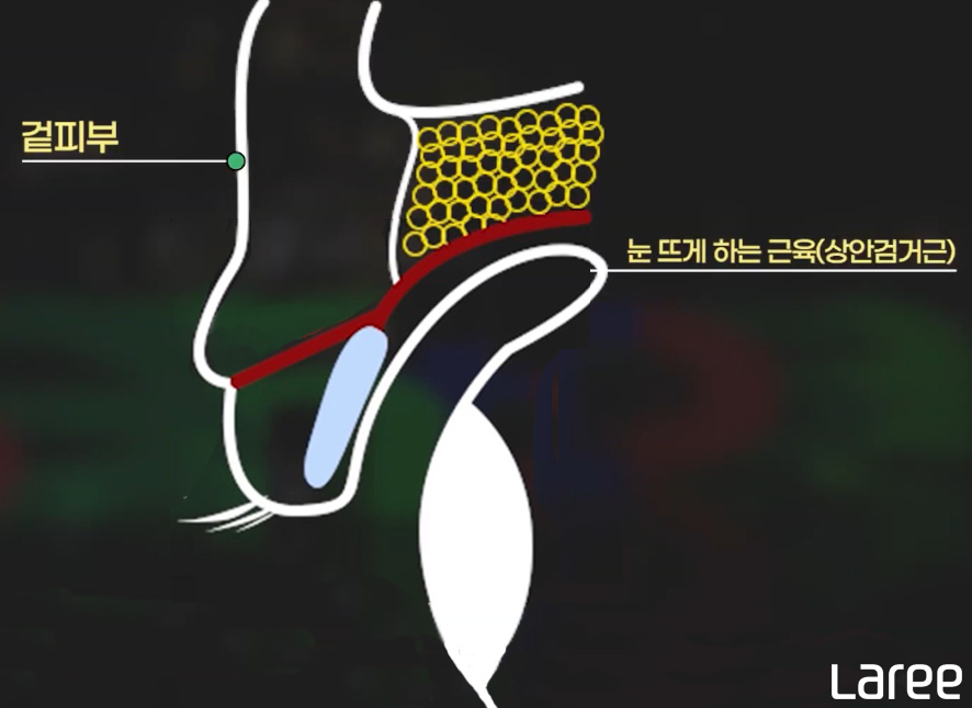[라리성형외과] 쌍꺼풀수술 후 쌍꺼풀이 풀리는 이유 관련 이미지 8