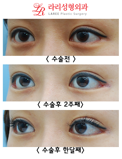8-Year Long-Term Follow-Up vs. 2-Week Short-Term Follow-Up in the Same Patient (Lateral Canthoplasty & Revision Lateral Canthoplasty) image 6