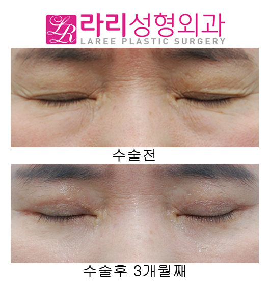 (Middle-aged) Upper Eyelid Surgery and Lower Eyelid Surgery at the Same Time image 2