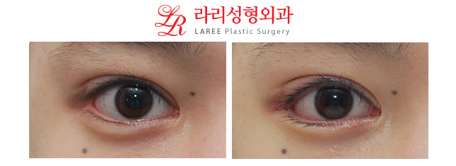 Before-and-After Photos of Micro Outer Canthoplasty with Lowering of the Outer Eye Corner☆ image 2