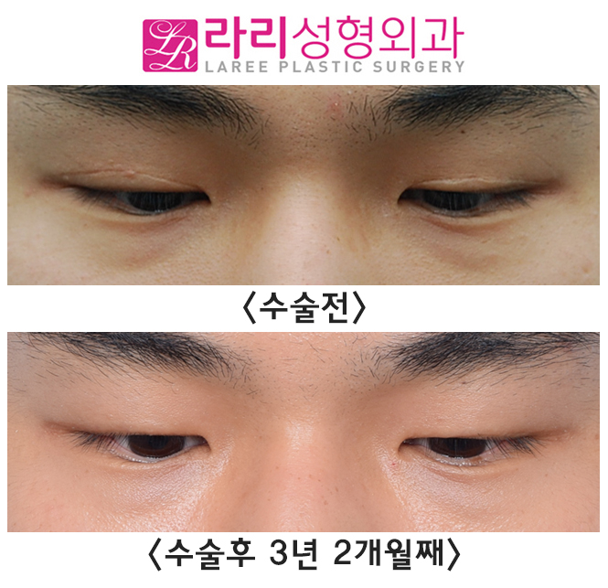 [라리성형외과] 절개 쌍꺼풀 부작용 풀림 현상 쌍꺼풀없애기 수술로 말끔하게 관련 이미지 4