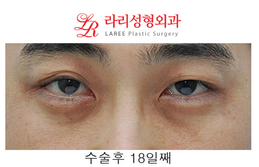 Under-Eye Fat Repositioning Before and After in Your 40s image 2