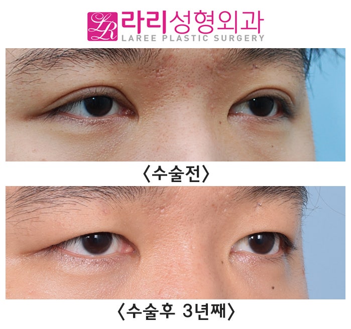 [Rari Plastic Surgery] Causes of Uneven Eye Size After Double Eyelid Removal Surgery, Cases That Naturally Even Out, Before-and-After Photos image 1