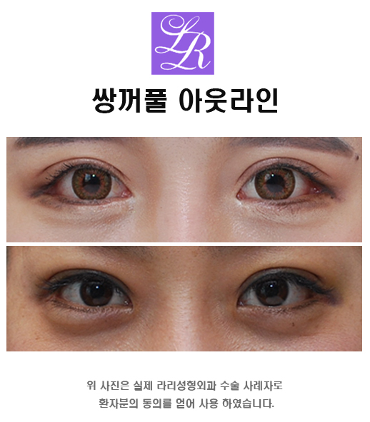 Eyes Suited to an In-Out Line Double Eyelid Design image 2