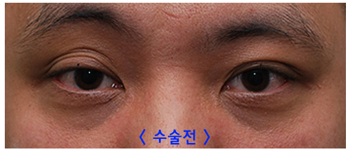 쌍꺼풀없애기 "나 대세임? " 관련 이미지 2