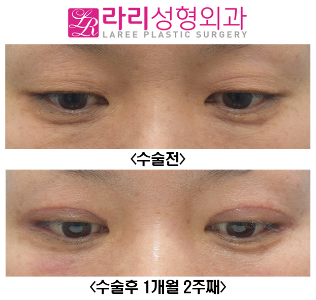 [라리성형외과] 자연스러운 절개눈매교정과 함께한 눈꼬리내리기뒤트임 수술전후 관련 이미지 3