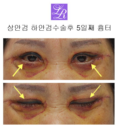 상안검수술, 하안검수술- 수술전후, 경과 궁금쓰 관련 이미지 5