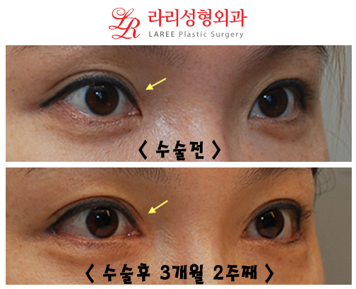 Before-and-After Photos of Epicanthoplasty / Canthoplasty image 4