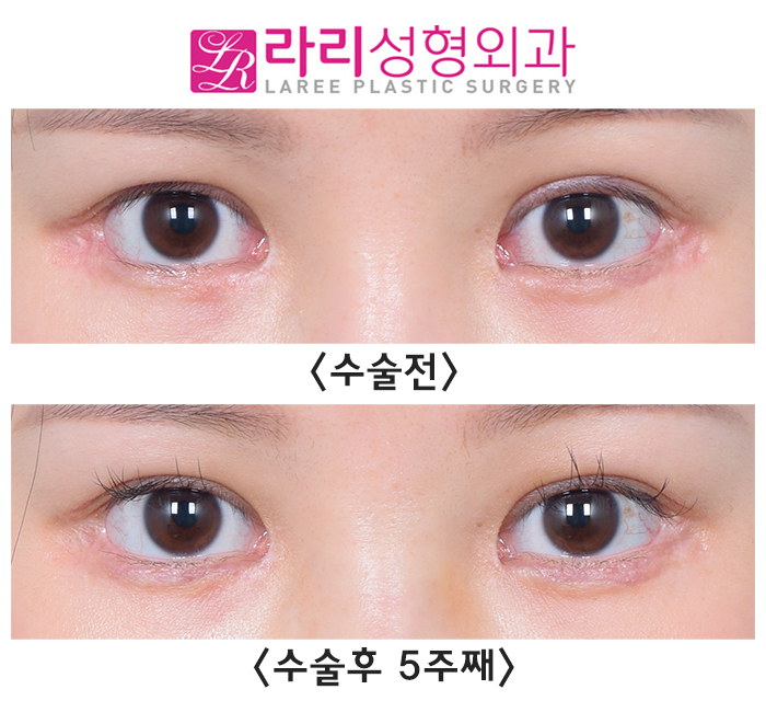 [라리성형외과] 한쪽 쌍수 재수술로 짝눈을 맞춰요. (절개쌍수라인낮추기) 관련 이미지 2