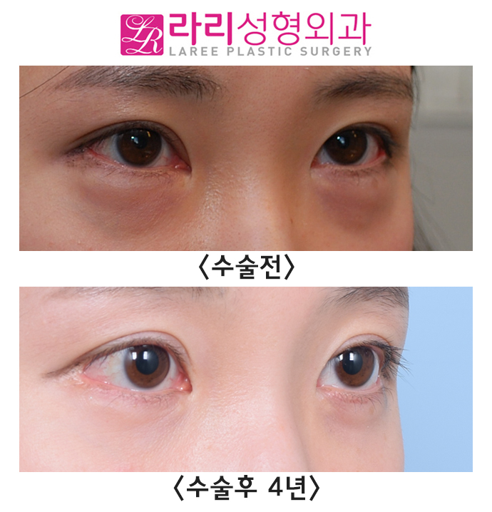 [라리성형외과] 뒤트임 부작용? 빨간살(결막노출) -재수술로 교정 관련 이미지 2