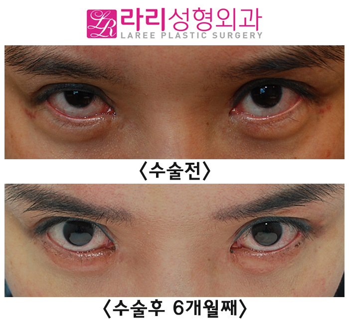 [Rari Plastic Surgery] Eyelid Ectropion Correction Surgery Methods According to Eye Condition image 5