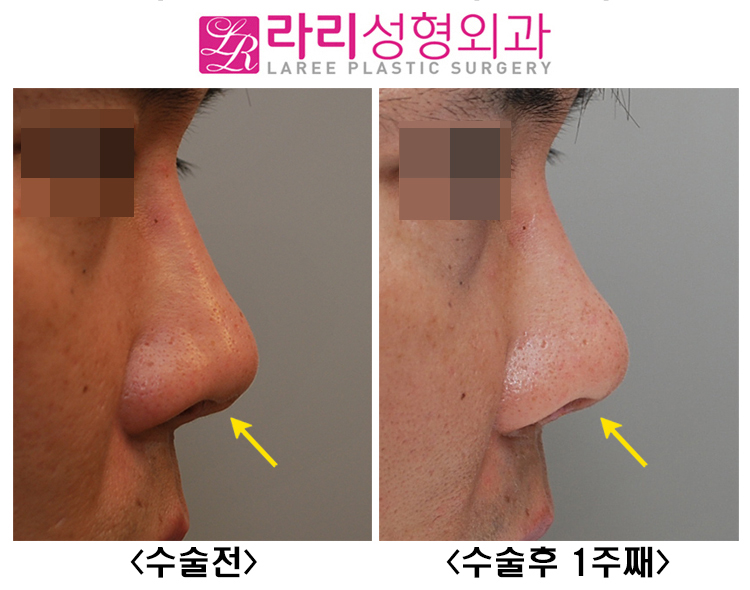 [라리성형외과] 코재수술 : 미용 목적만이 아닌 경우, 복원과 재건 관련 이미지 2