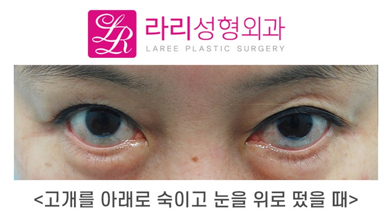 [Laree Plastic Surgery] My Eyelid Margin Is Turned Out—Could This Be Ectropion?!! (Self-Check by Symptoms) image 2